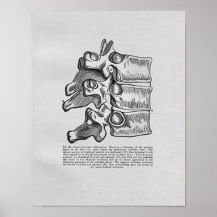 Chiropractic Vertebral Subluxation Vintage Print