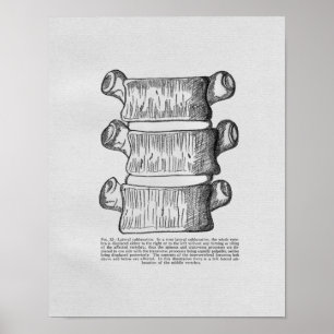 Chiropractic Vertebral Subluxation Vintage Print