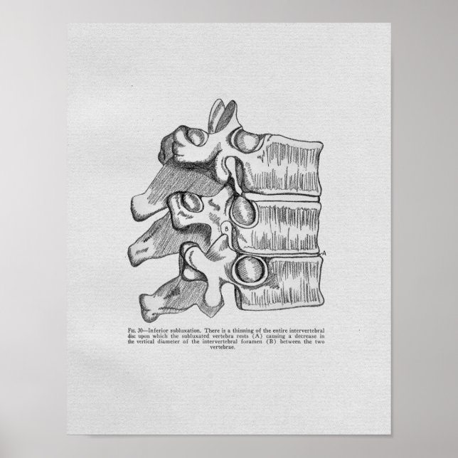 Chiropractic Vertebral Subluxation Vintage Print (Front)