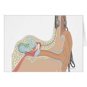 Cochlear Implants