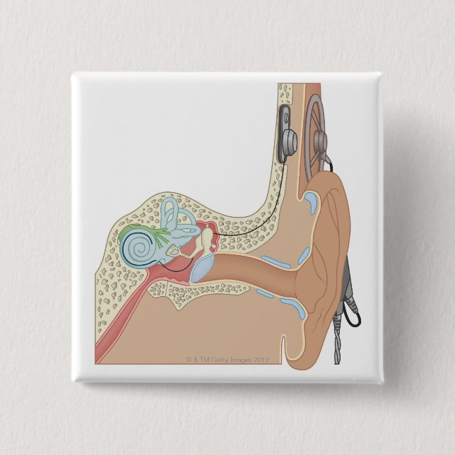 Cochlear Implants 15 Cm Square Badge (Front)