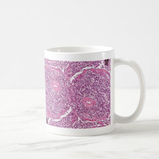 Coffe Mug-Lung Cancer Cells Coffee Mug (Right)