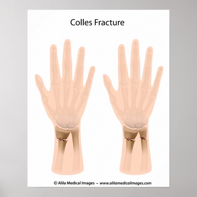 Colles fracture, medical illustration. poster (Front)