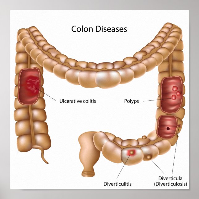 Colon pathologies Poster (Front)
