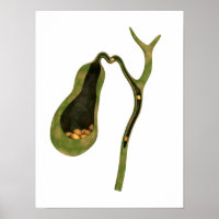 Conceptual Image Of Gallstones Inside Gall