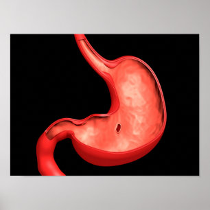 Conceptual Image Of Peptic Ulcer In Stomach Poster