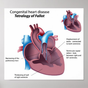 Congenital heart disease Poster