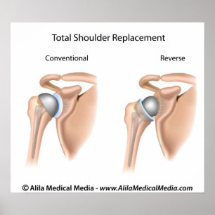 Conventional vs reverse total shoulder replacement poster