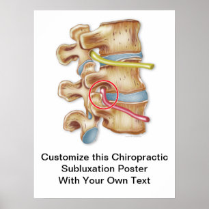 Customise Chiropractic Subluxation Poster