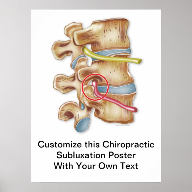 Customise Chiropractic Subluxation Poster (Front)