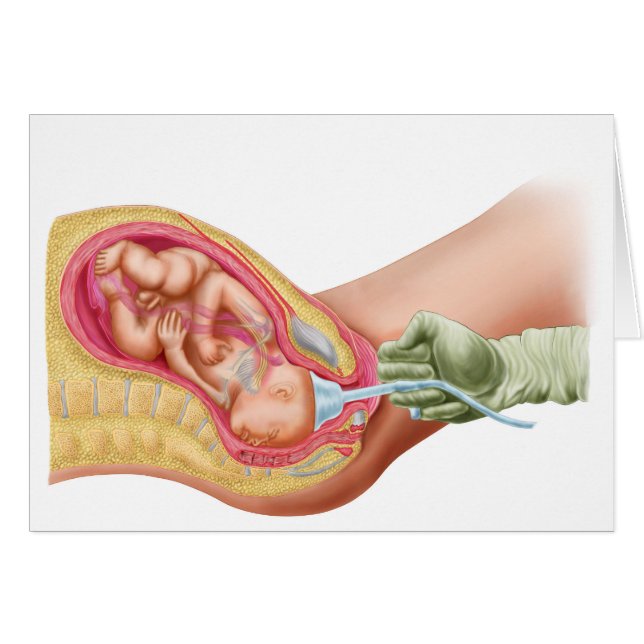 Delivery Of Foetus Using Vacuum Extraction (Front Horizontal)