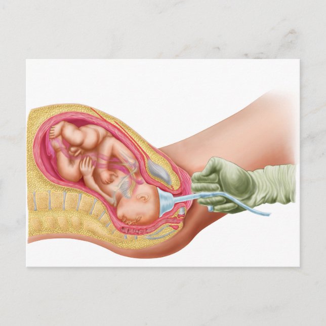 Delivery Of Foetus Using Vacuum Extraction Postcard (Front)