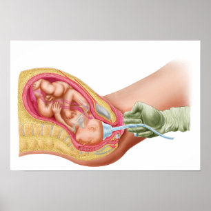 Delivery Of Foetus Using Vacuum Extraction Poster