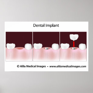 Dental implant procedure Poster