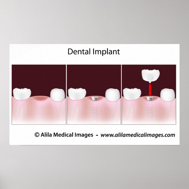 Dental implant procedure Poster (Front)