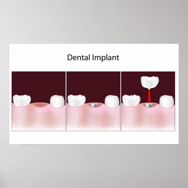 Dental implant procedure Poster (Front)