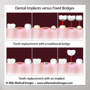 Dental implant versus bridge Poster