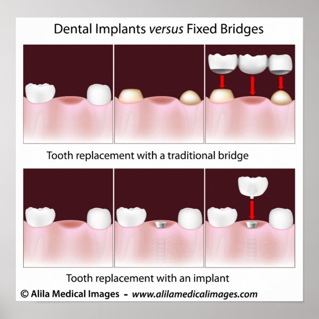 Dental implant versus bridge Poster (Front)
