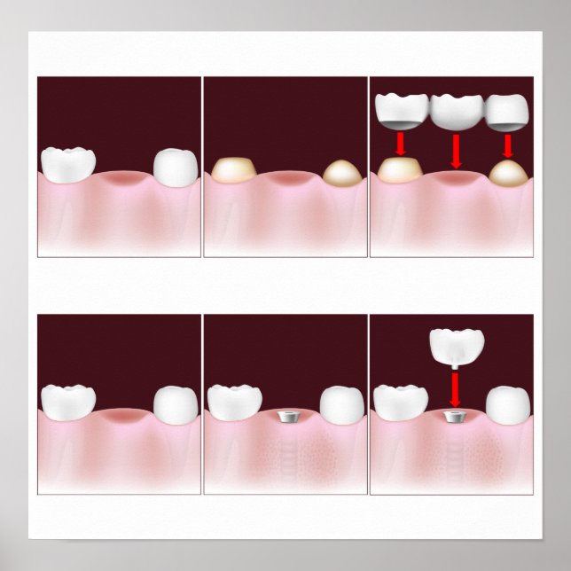 Dental implants vs fixed bridge, add your text! poster (Front)