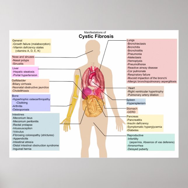 Detailed Chart of the Symptoms of Cystic Fibrosis (Front)