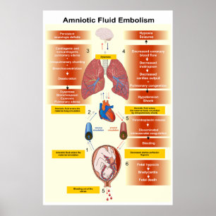 Diagram of an Amniotic Fluid Embolism AFE Poster