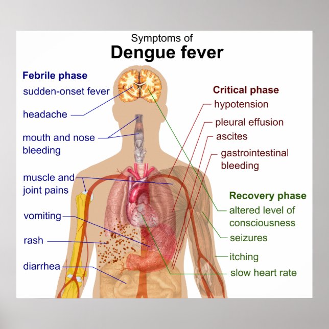 Diagram of the Main Symptoms of Dengue Fever Poster (Front)