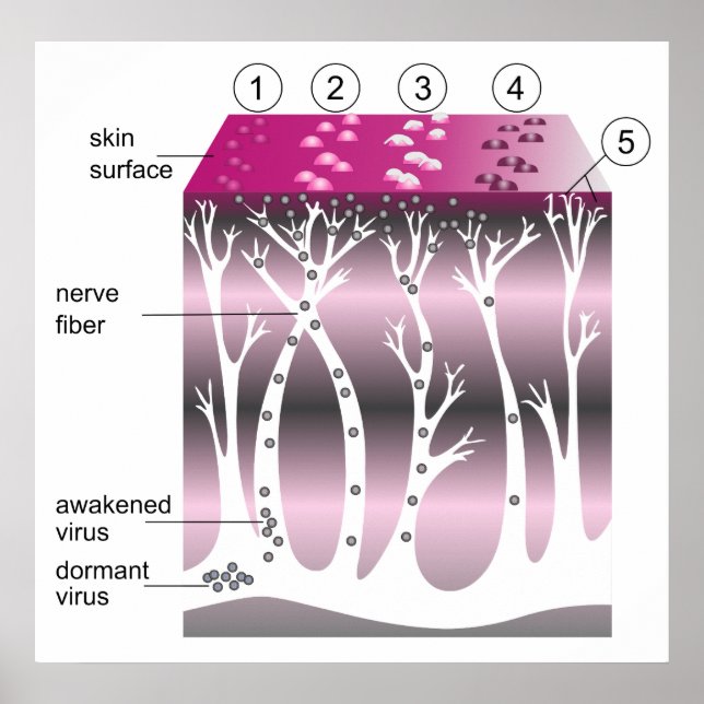 Diagram of the Progression of Shingles on Skin Poster (Front)