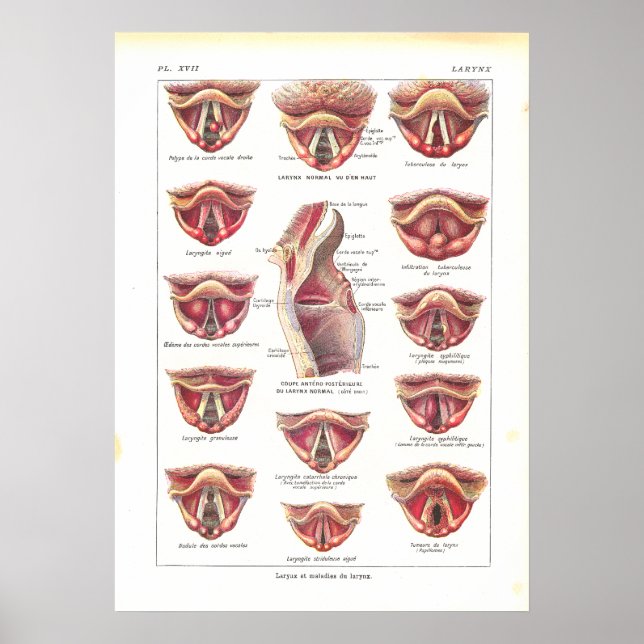 Diseases of Larynx Anatomy Poster French (Front)