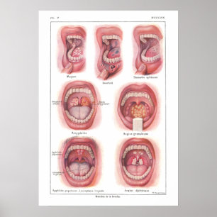 Diseases of Mouth Anatomy Poster French