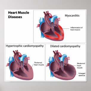 Diseases of the Heart Muscle Poster