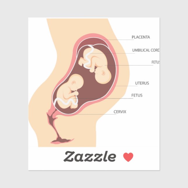 Dizygotic twin pregnancy (Sheet)