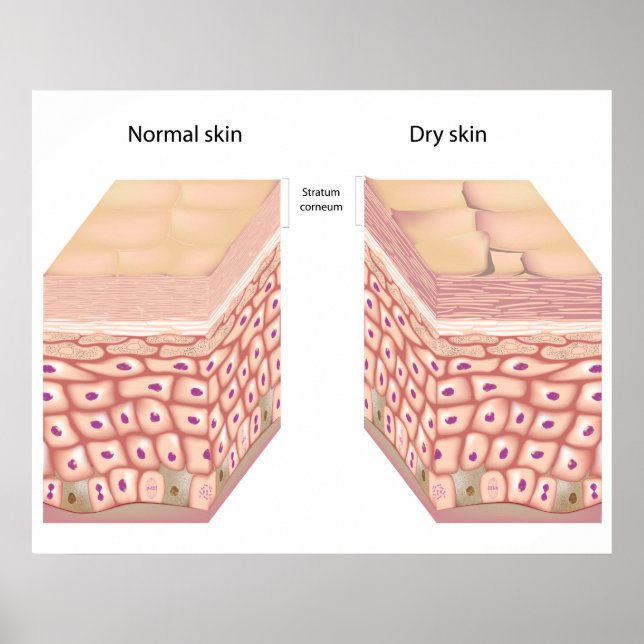 Dry skin Poster (Front)