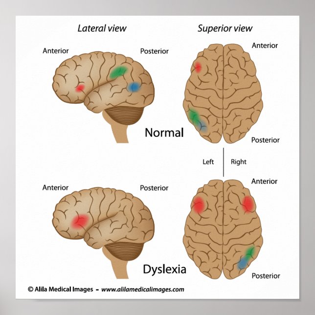 Dyslexia brain activity Poster (Front)