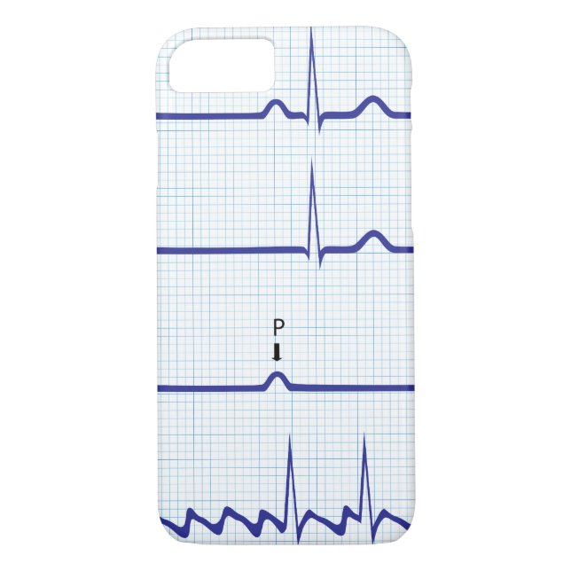 ECG/EKG iPhone case (Back)