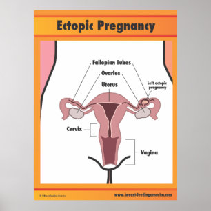 Ectopic Pregnancy Poster