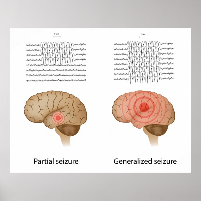 EEG in partial and generalised epilepsy Poster (Front)