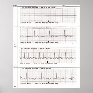 ekg Rhythms Poster