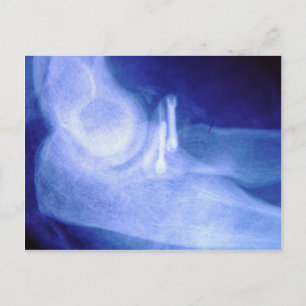 Elbow xray with screws postcard