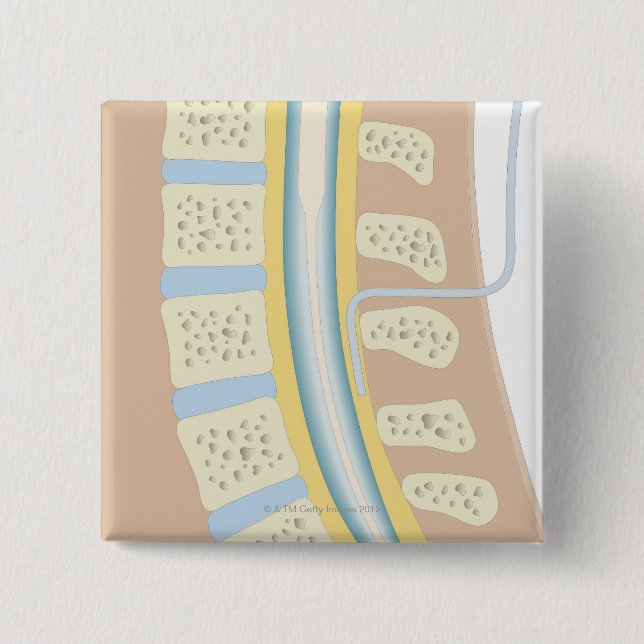 Epidural Anaesthesia 15 Cm Square Badge (Front)