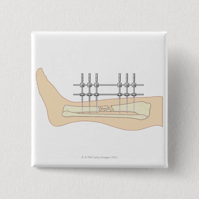 External Fixator 15 Cm Square Badge (Front)