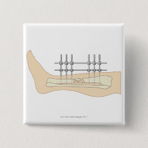 External Fixator 15 Cm Square Badge