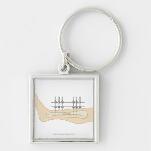 External Fixator Key Ring