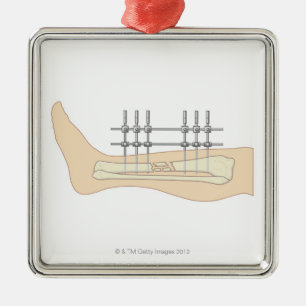 External Fixator Metal Tree Decoration