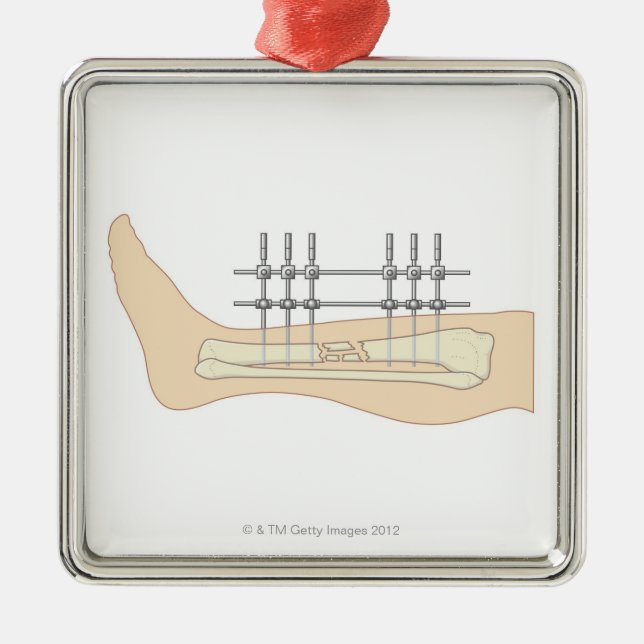 External Fixator Metal Tree Decoration (Front)