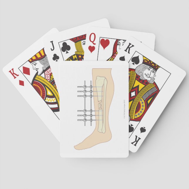 External Fixator Playing Cards (Back)