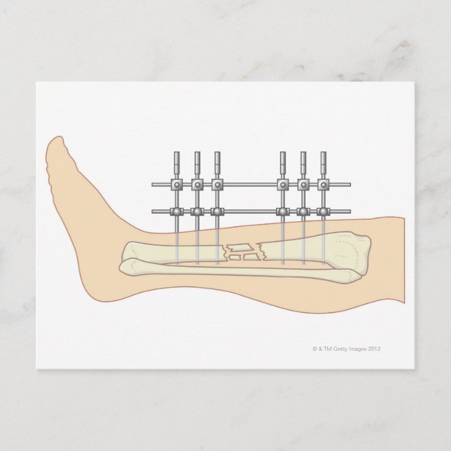 External Fixator Postcard (Front)