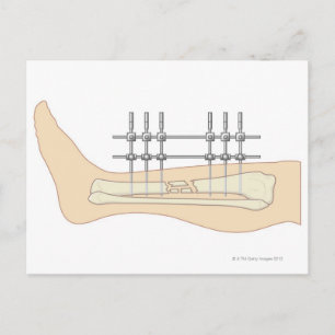 External Fixator Postcard