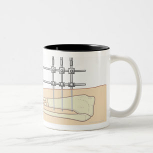 External Fixator Two-Tone Coffee Mug