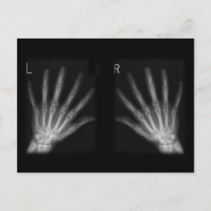 Extra Digit X-ray Right & Left Hands Postcard