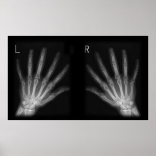 Extra Digit X-ray Right & Left Hands Poster